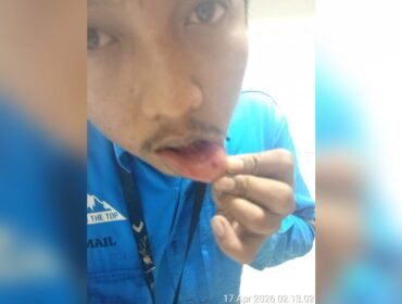 Seorang karyawan PT Putra Perkasa Abadi (PPA) Konawe Utara mengalami luka pada bibir setelah menjadi korban penganiayaan di lingkungan perusahaan. Foto: Istimewa
