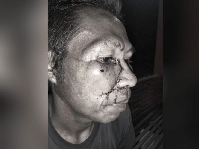 
 Warga bernama Desa Lakalamba Kecamatan Sawerigadi Ajidin (44) mengalami luka pada bagian wajah usai diduga dianiaya oleh sorang Ketua BPD, insial DR. Foto: Istimewa.
